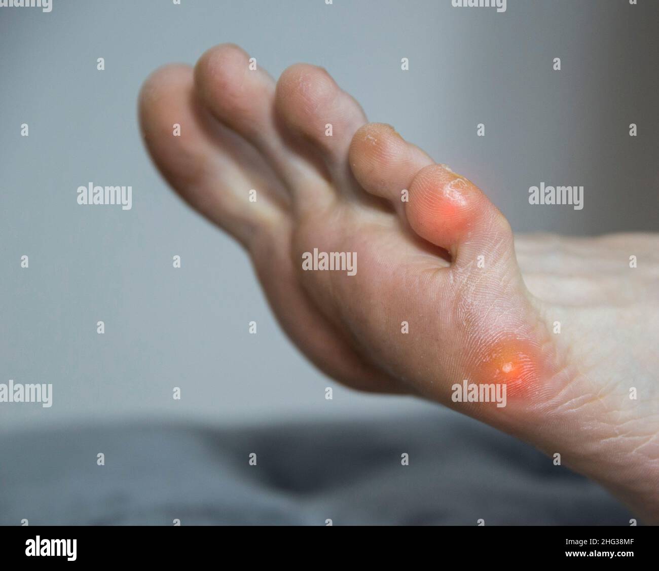 Plantar wart on the foot and little toe in humans. Treatment and removal of warts on the sole in