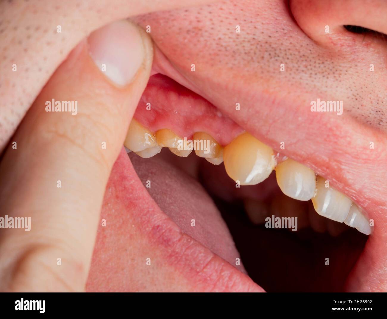 Dissected teeth in the patient's mouth during crown prosthetics