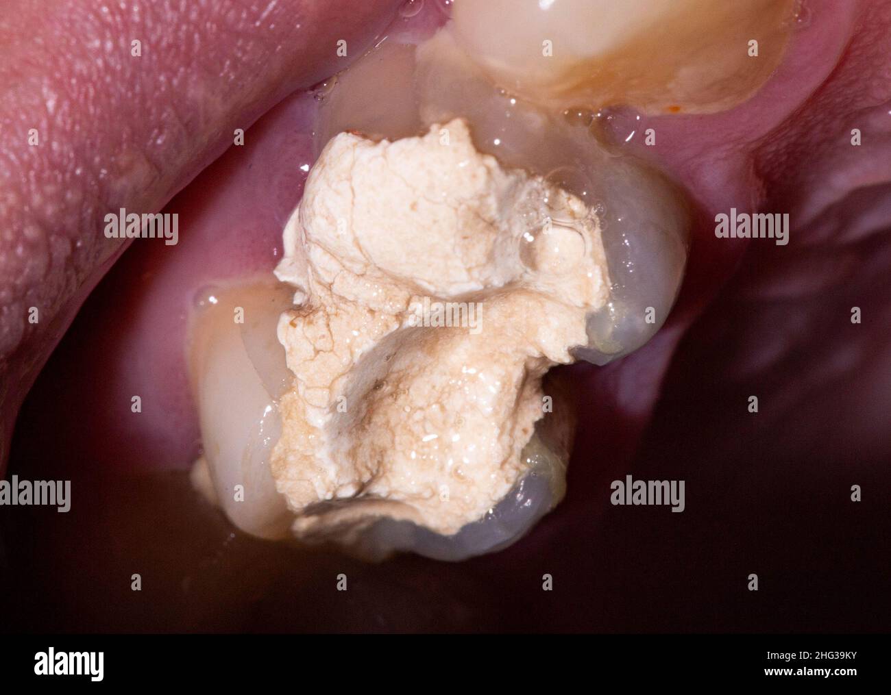 Installation of a temporary filling in the treatment of tooth canals