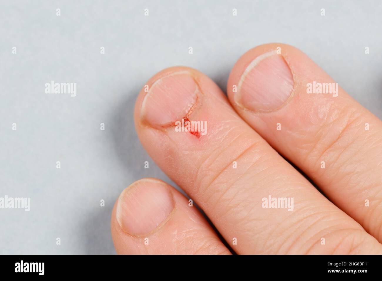 Thumb Trauma. Bleeding from a Cut Finger Stock Photo - Image of hospital,  care: 196274284