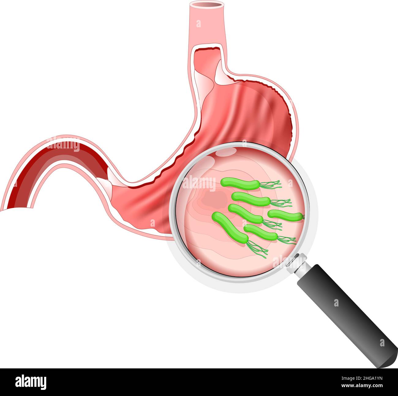 Helicobacter pylori bacteria. stomach with Peptic ulcer disease, and Magnifying glass. Vector illustration Stock Vector