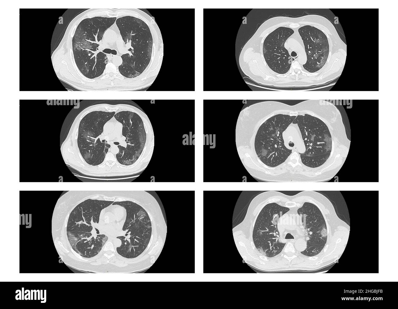 Xray findings of patients with COVID19 tomography