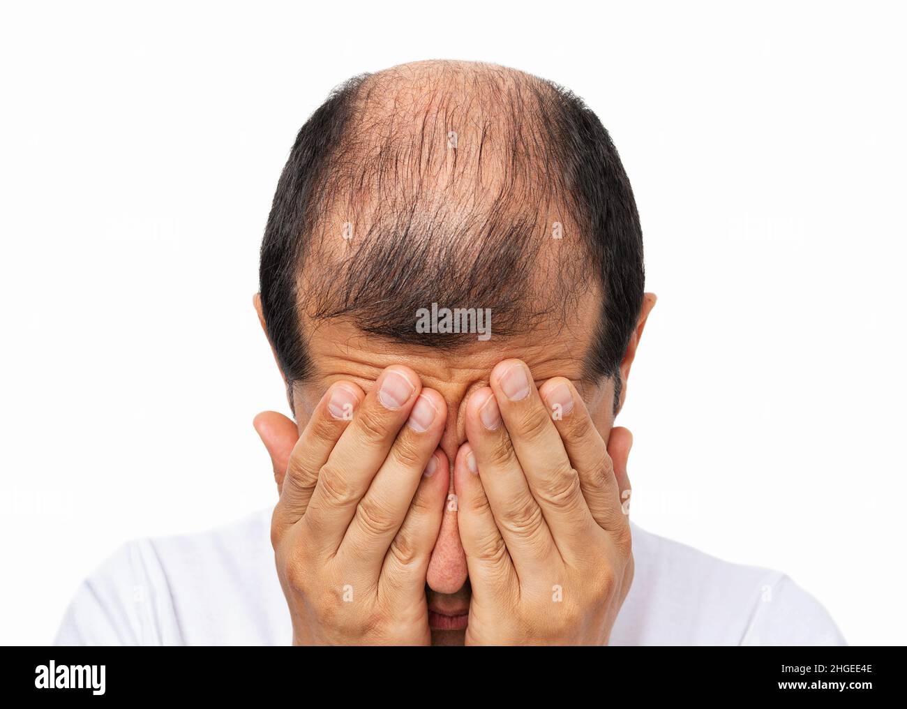 Close-uo of bald man stressed by rapid hair loss against a white background Stock Photo
