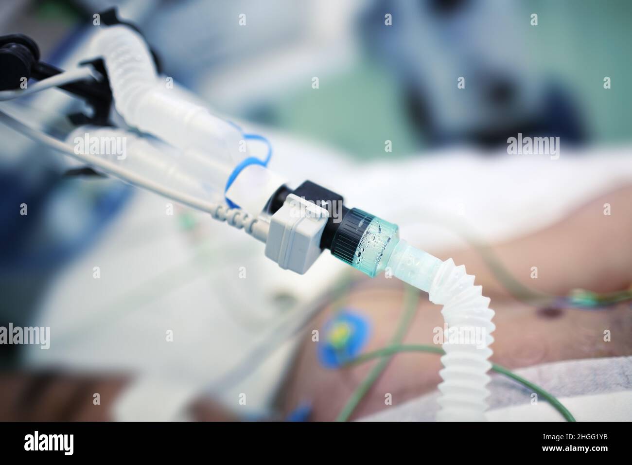 Artificial lung ventilation tube connected to the patient in the bed. Stock Photo