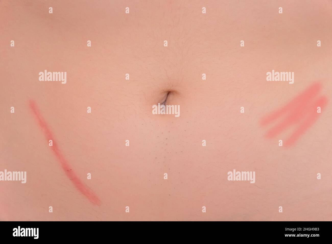 Body abdomen skin scar after removal of appendicitis surgery consequences of surgery, close-up. Stock Photo