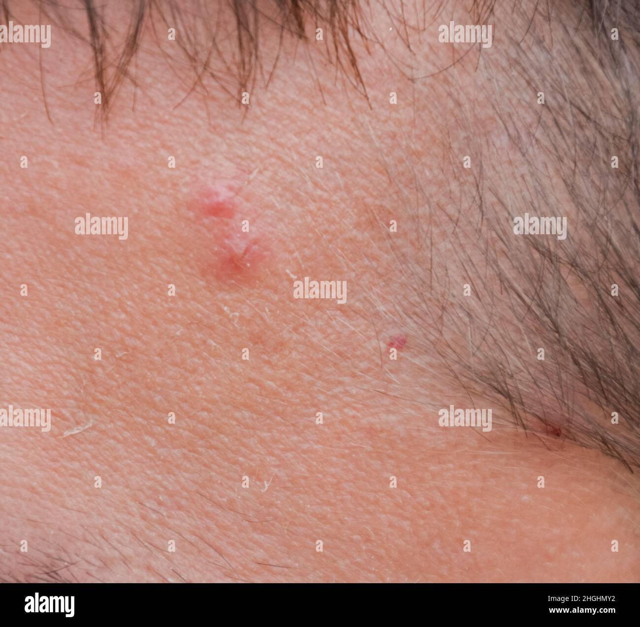 Pimples on the forehead of a man. Acne on the forehead Stock Photo - Alamy
