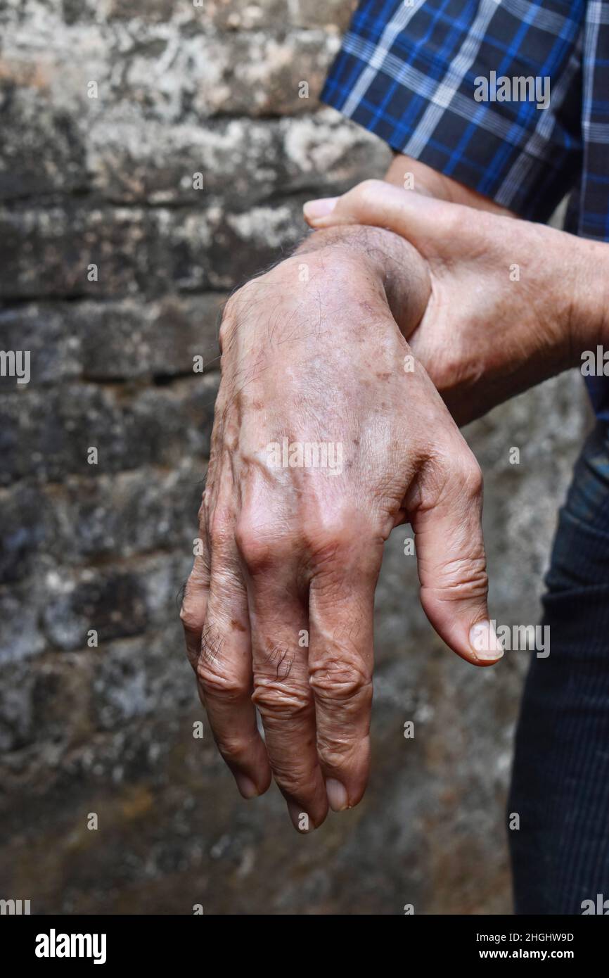 Radial nerve injury or wrist drop of Asian elder man. Stock Photo