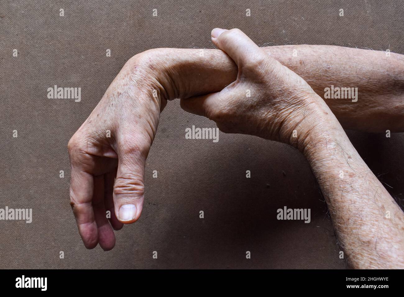 Radial nerve injury or wrist drop of Asian old man Stock Photo Alamy