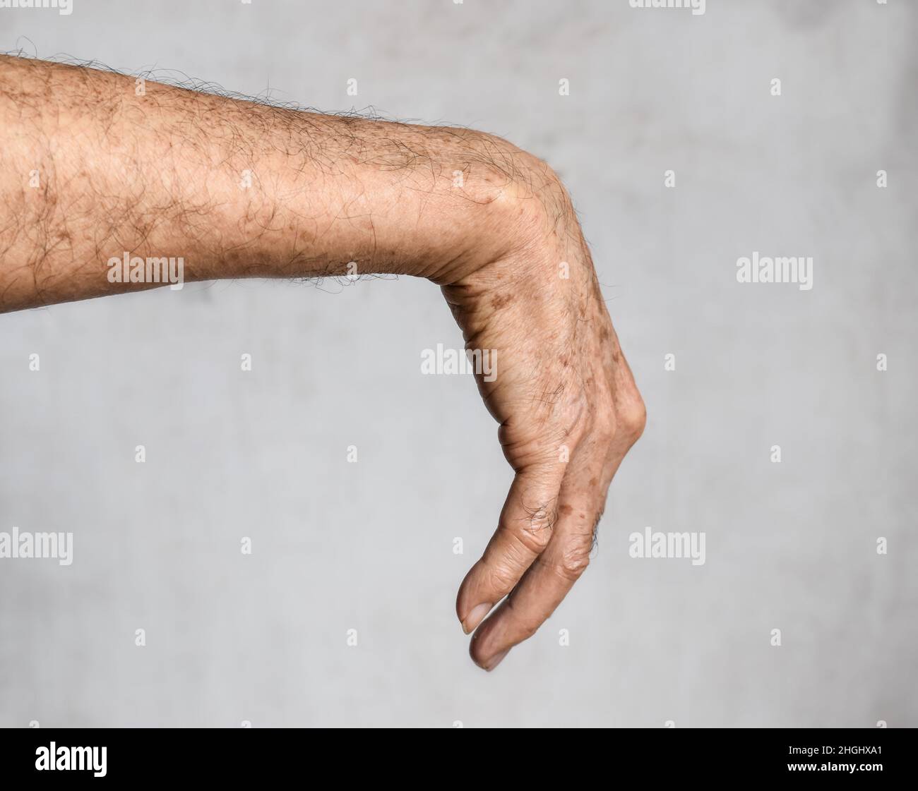 Radial nerve injury or wrist drop of Asian elder man Stock Photo Alamy