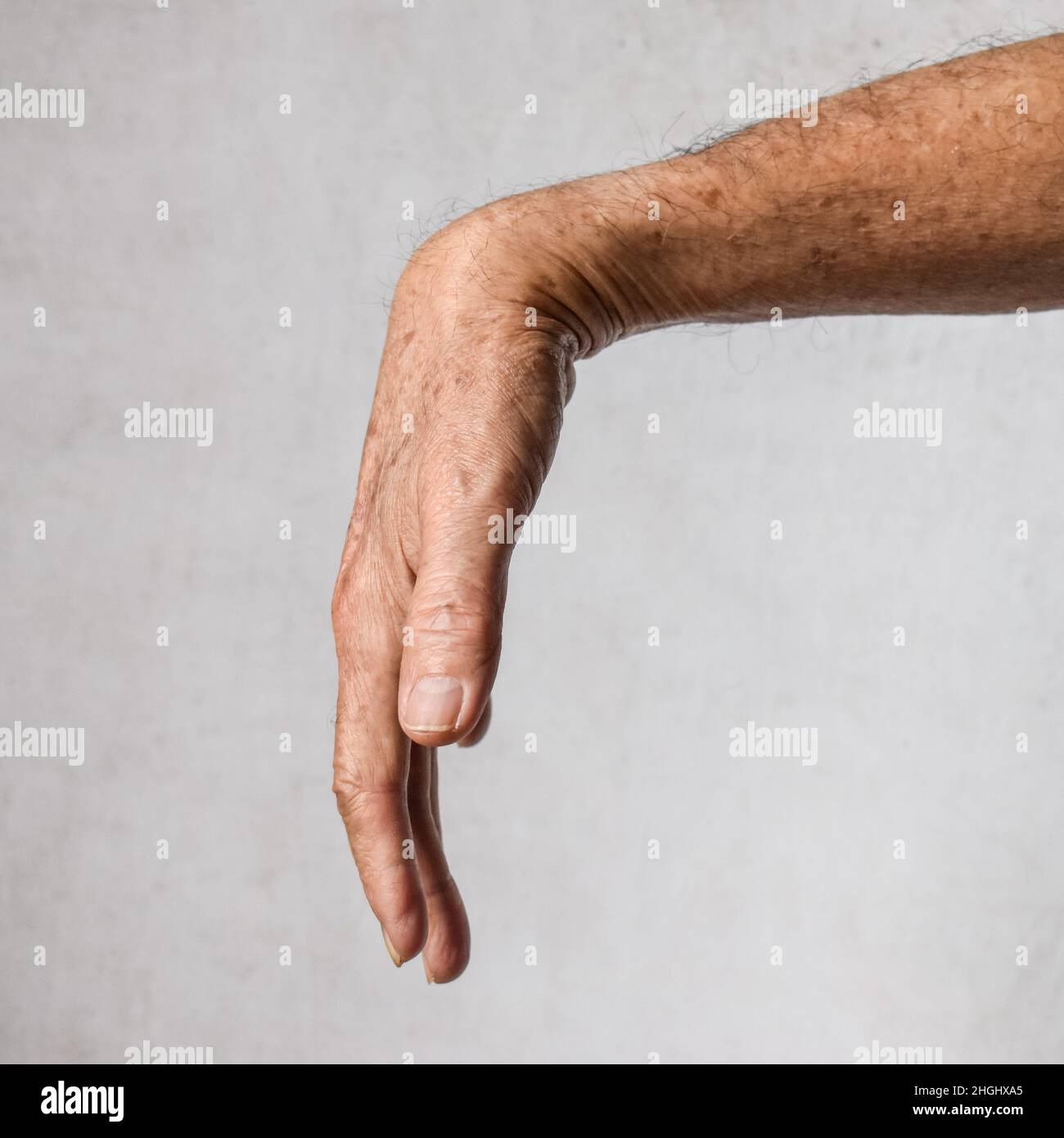 Radial nerve injury or wrist drop of Asian elder man. Stock Photo