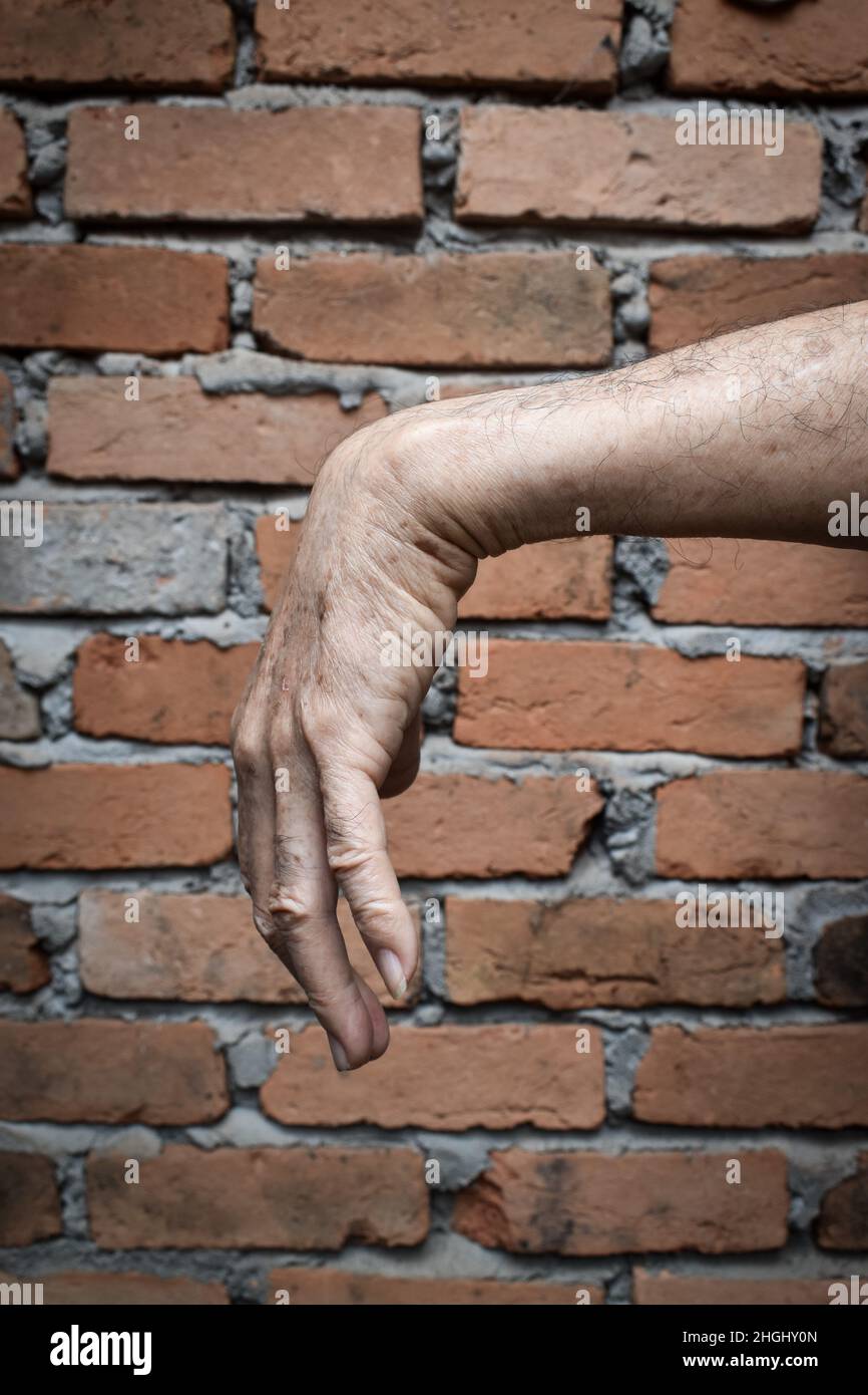Radial nerve injury or wrist drop of Asian old man. Stock Photo
