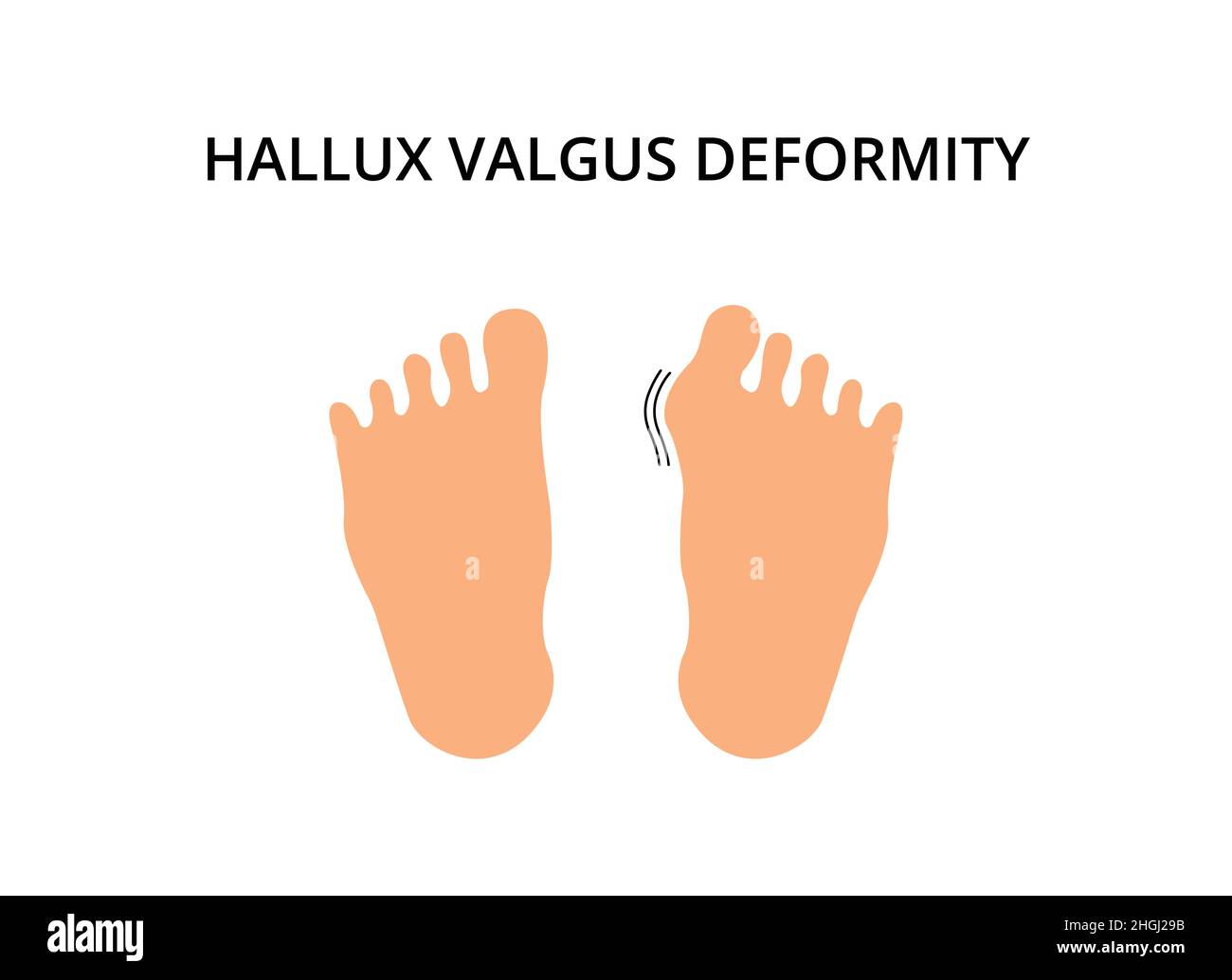 Foot with hallux valgus deformity. Bunion, problem, orthopedics. For topics like symptom, bone, podiatry Stock Vector