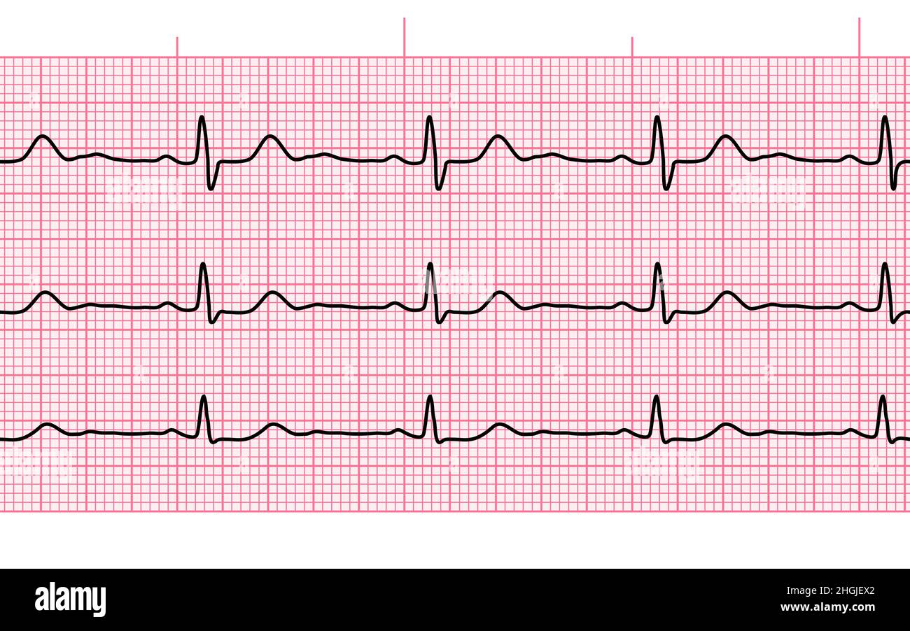 Heart beat ecg or ekg seamless black line on pink paper 