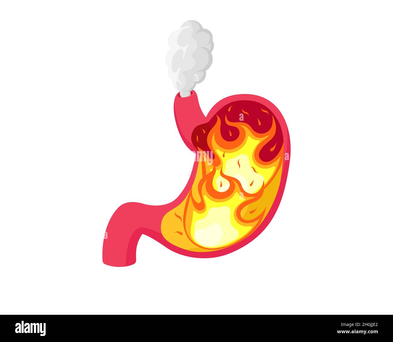 Inflamed Esophagus Cut Out Stock Images Pictures Alamy inflamed-esophagus-cut-out-stock-images-pictures-alamy