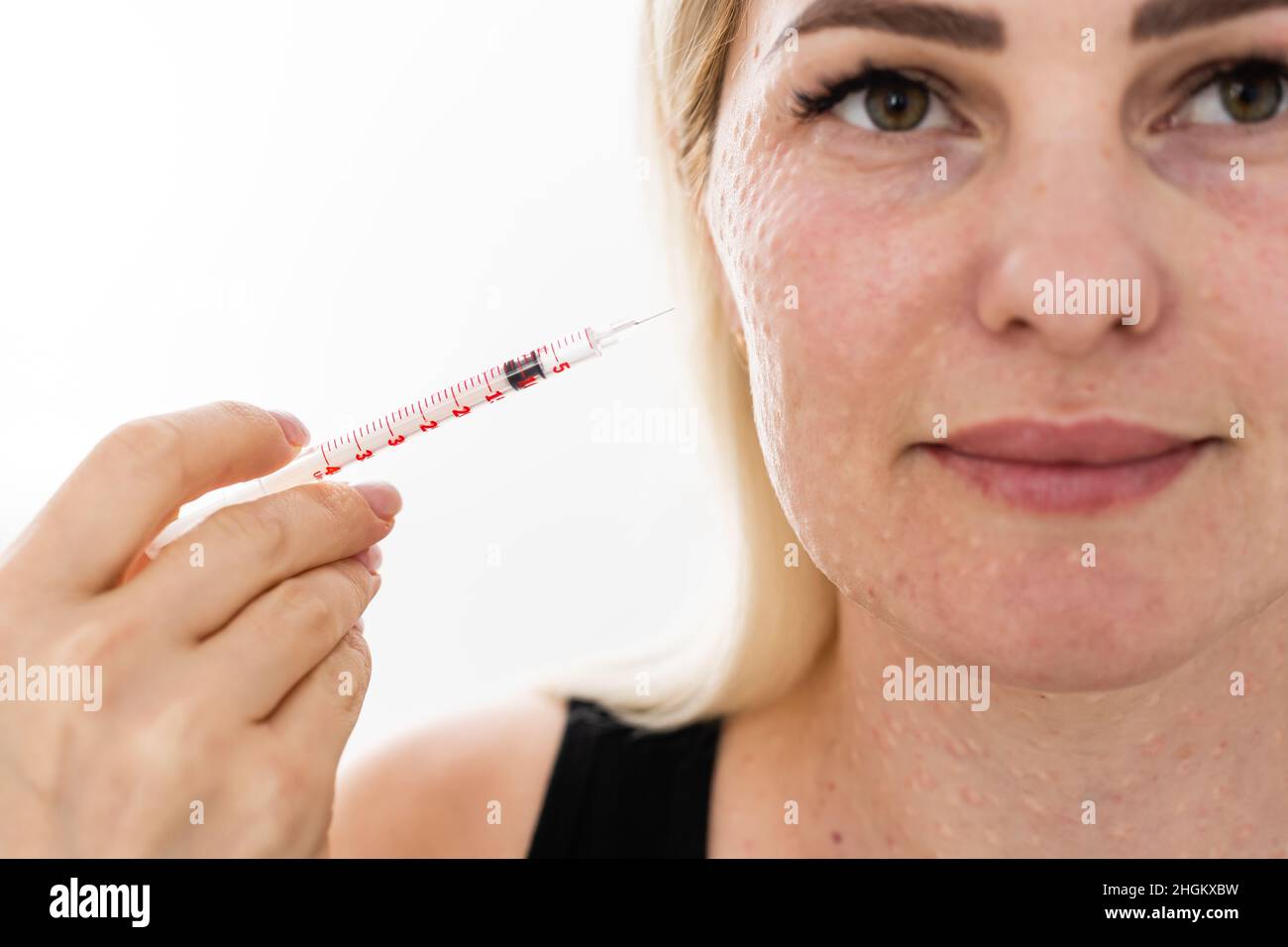 Mesotherapy in the neck and chestneckline. Traces of hyaluronic acid