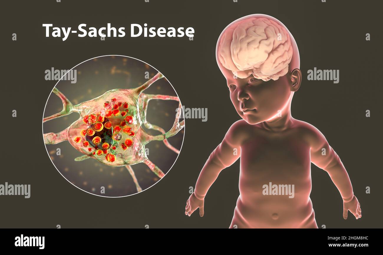 Tay-Sachs disease, computer illustration Stock Photo
