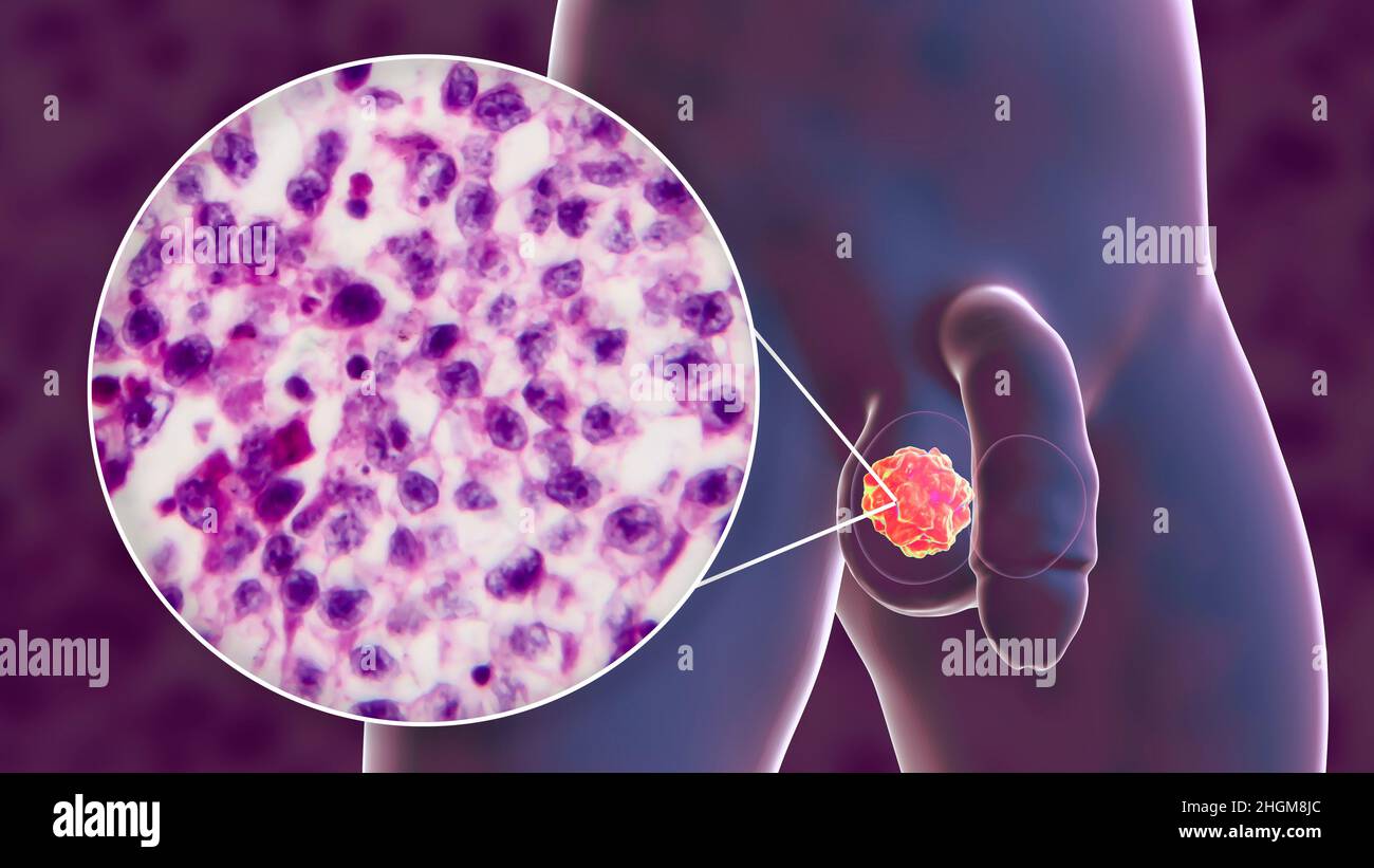 Testicular cancer, illustration and light micrograph Stock Photo