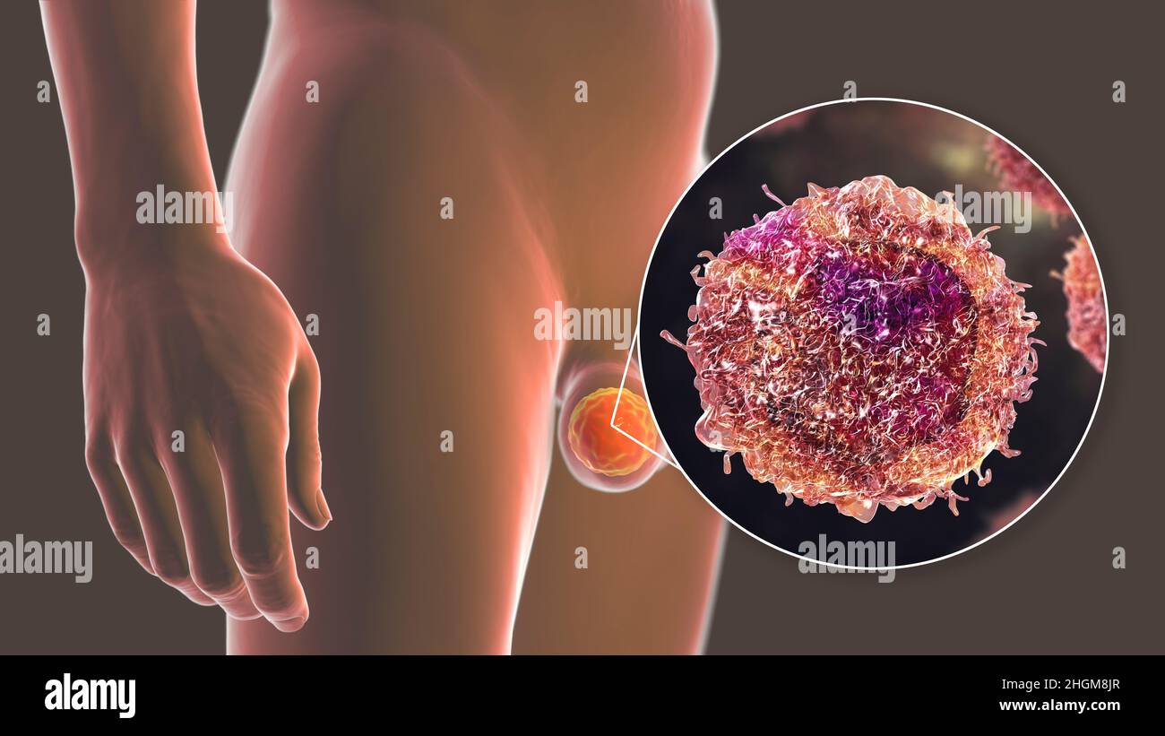 Testicular cancer, illustration Stock Photo Alamy