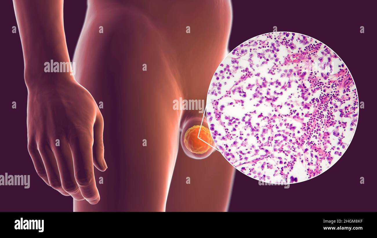 Testicular cancer, illustration and light micrograph Stock Photo