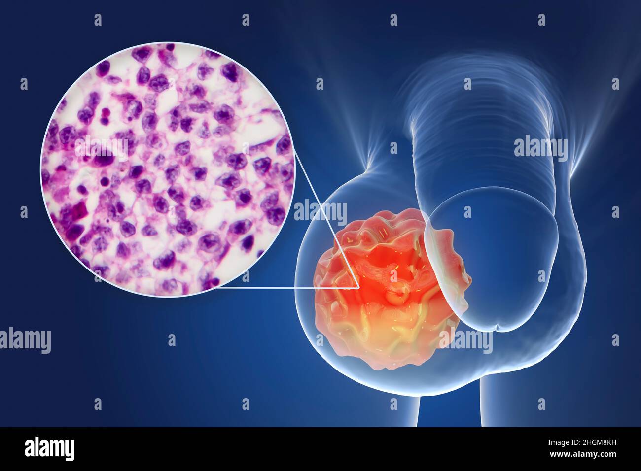 Testicular cancer, illustration and light micrograph Stock Photo Alamy