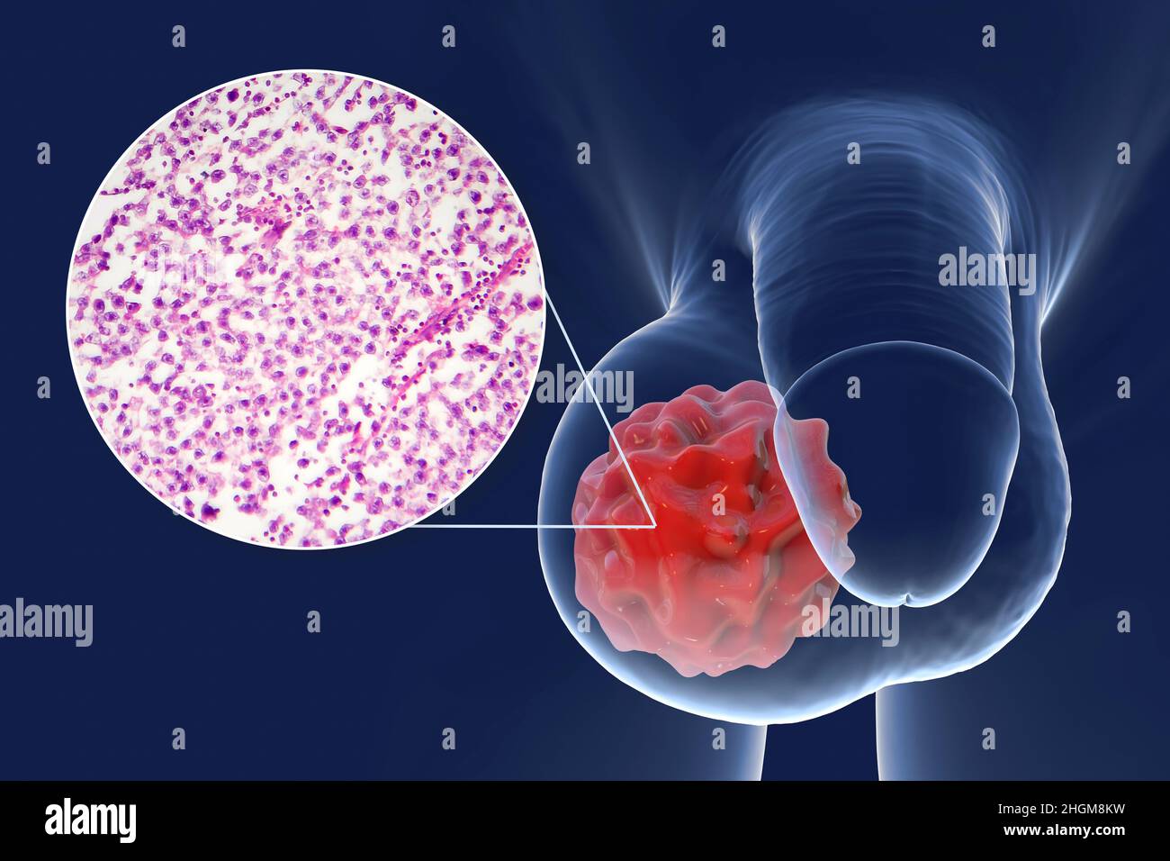 Testicular cancer, illustration and light micrograph Stock Photo Alamy