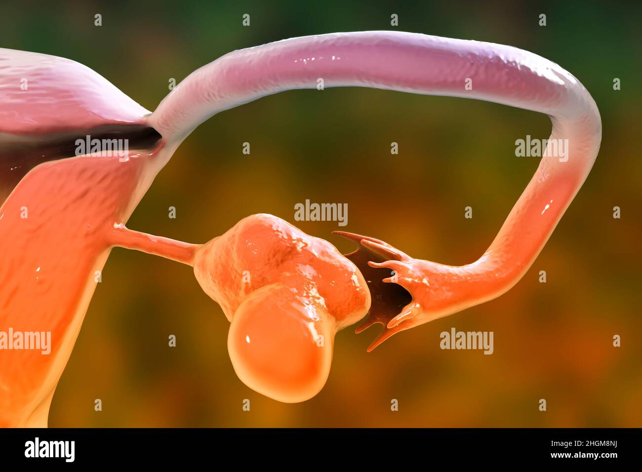 Polycystic ovary syndrome, illustration Stock Photo Alamy