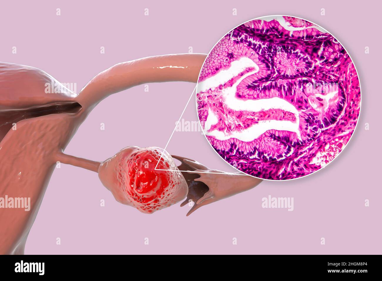 Ovarian cancer, illustration Stock Photo Alamy