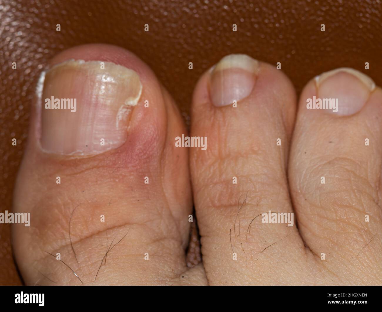 detail of a toe with a nail problem Stock Photo
