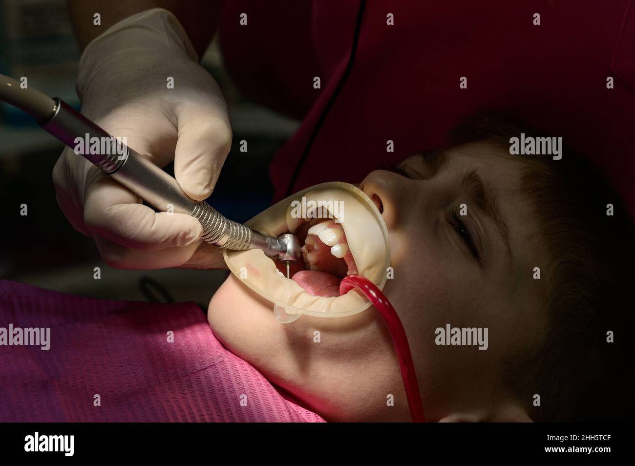 Dentist cleans tooth decay in a child with a drill, in the mouth of a