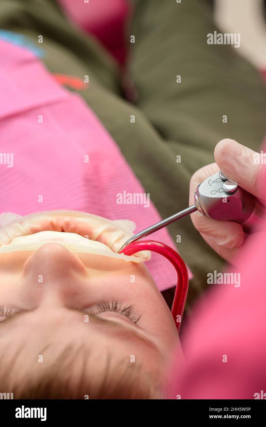 Dental treatment of the child, removal of caries with a drill, open