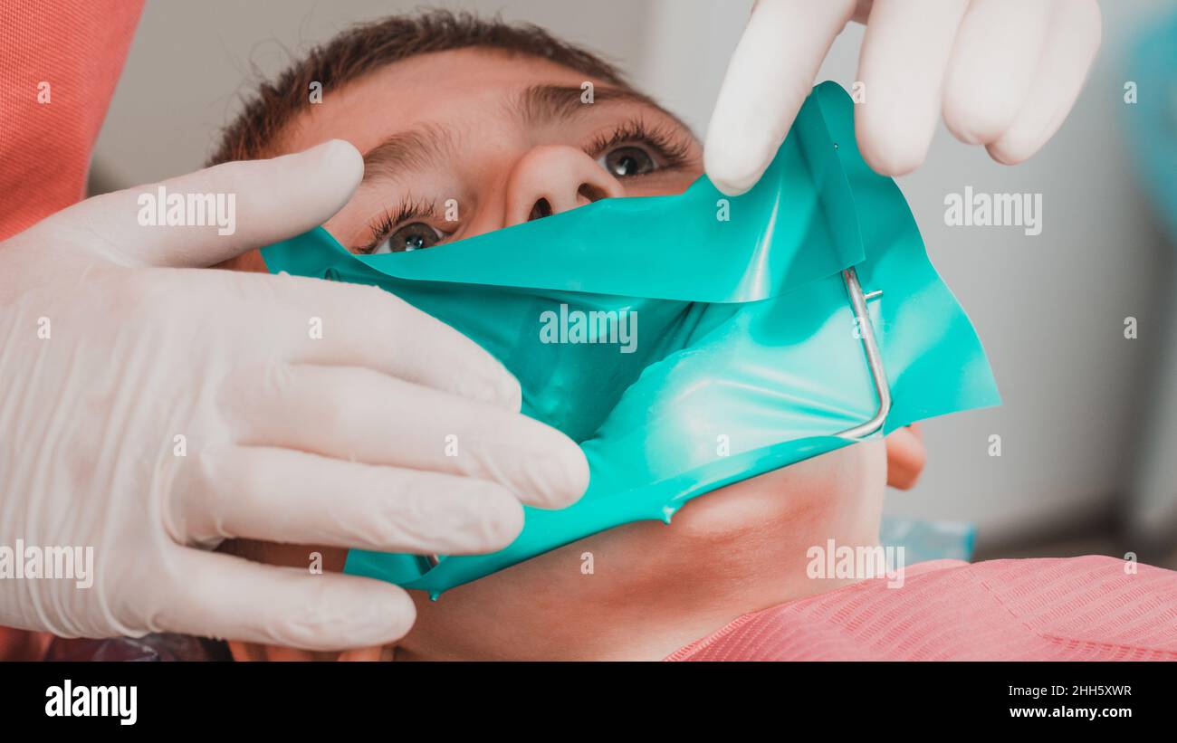 The dentist installs a rubber dam and a clamp for the treatment of a