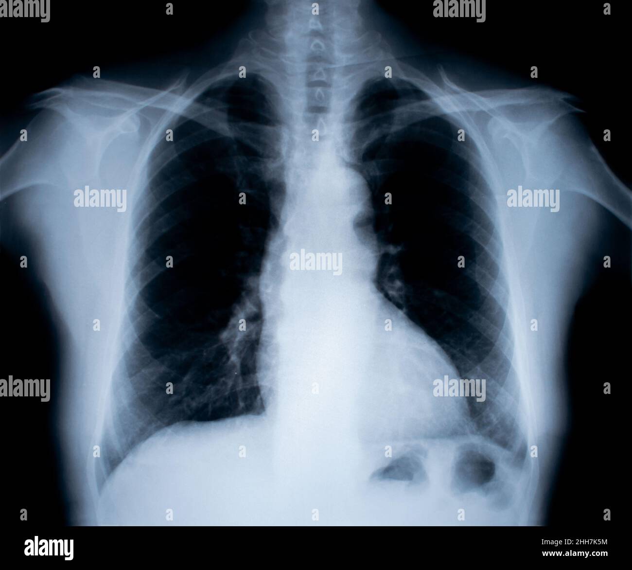 X-Ray image isolated on white Stock Photo
