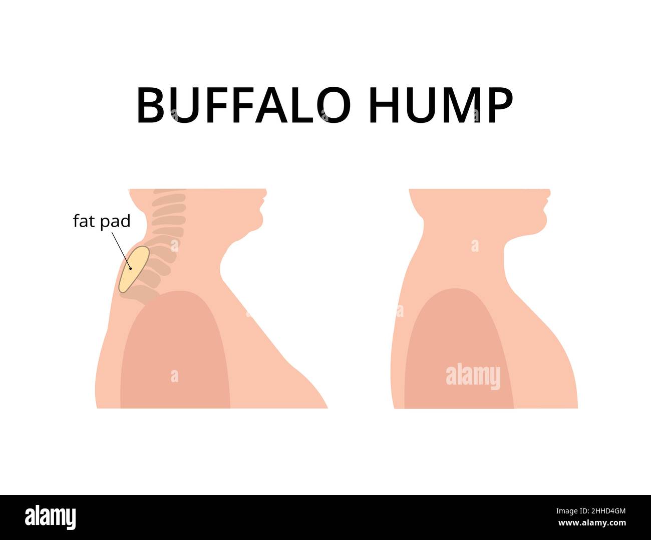 Patient with buffalo hump with fat deposits around the vertebrae. Dowager's hump, kyphosis, spine. For topics like post-menopause, osteoperosis, scoli Stock Vector