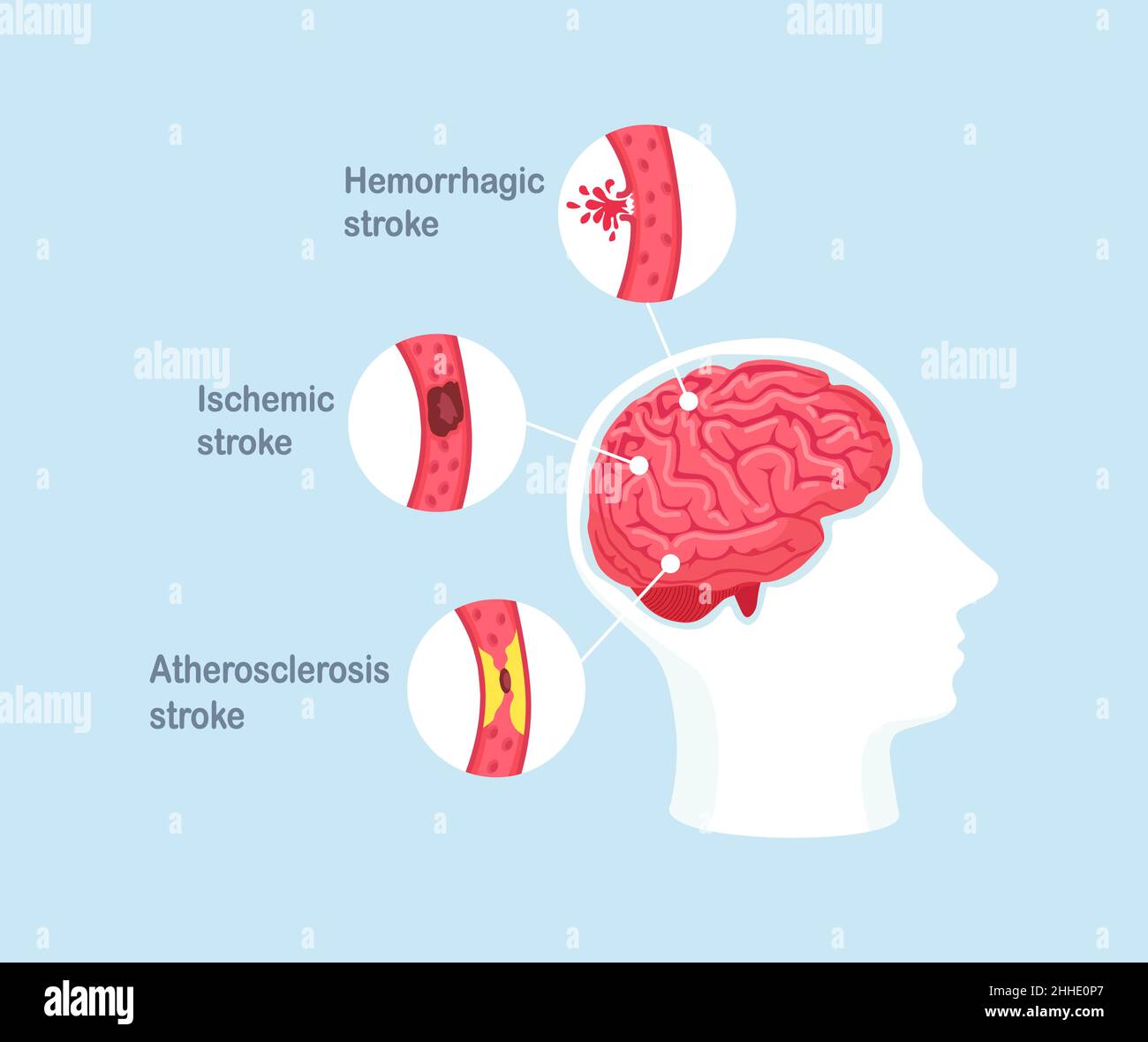Hemorrhagic Stroke High Resolution Stock Photography and Images - Alamy