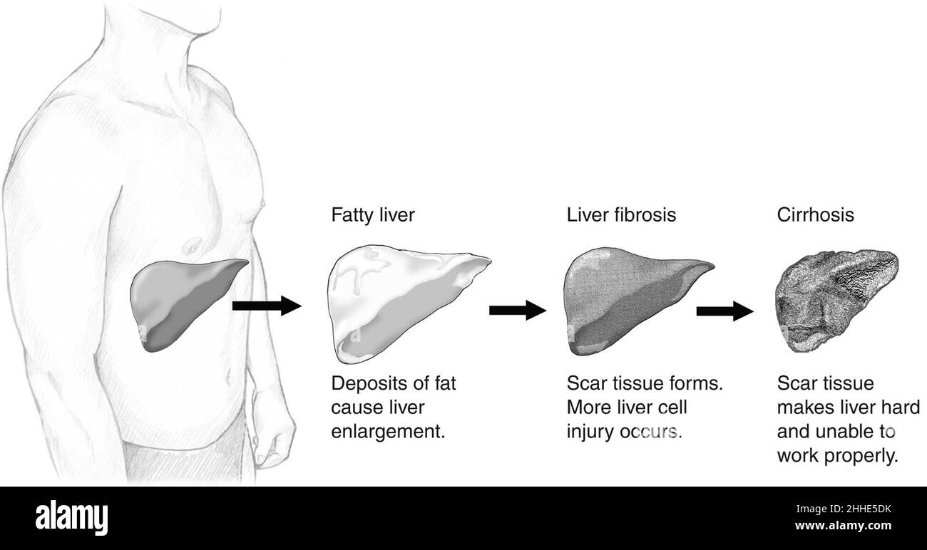 Stage of liver damage high Stock Photo Alamy