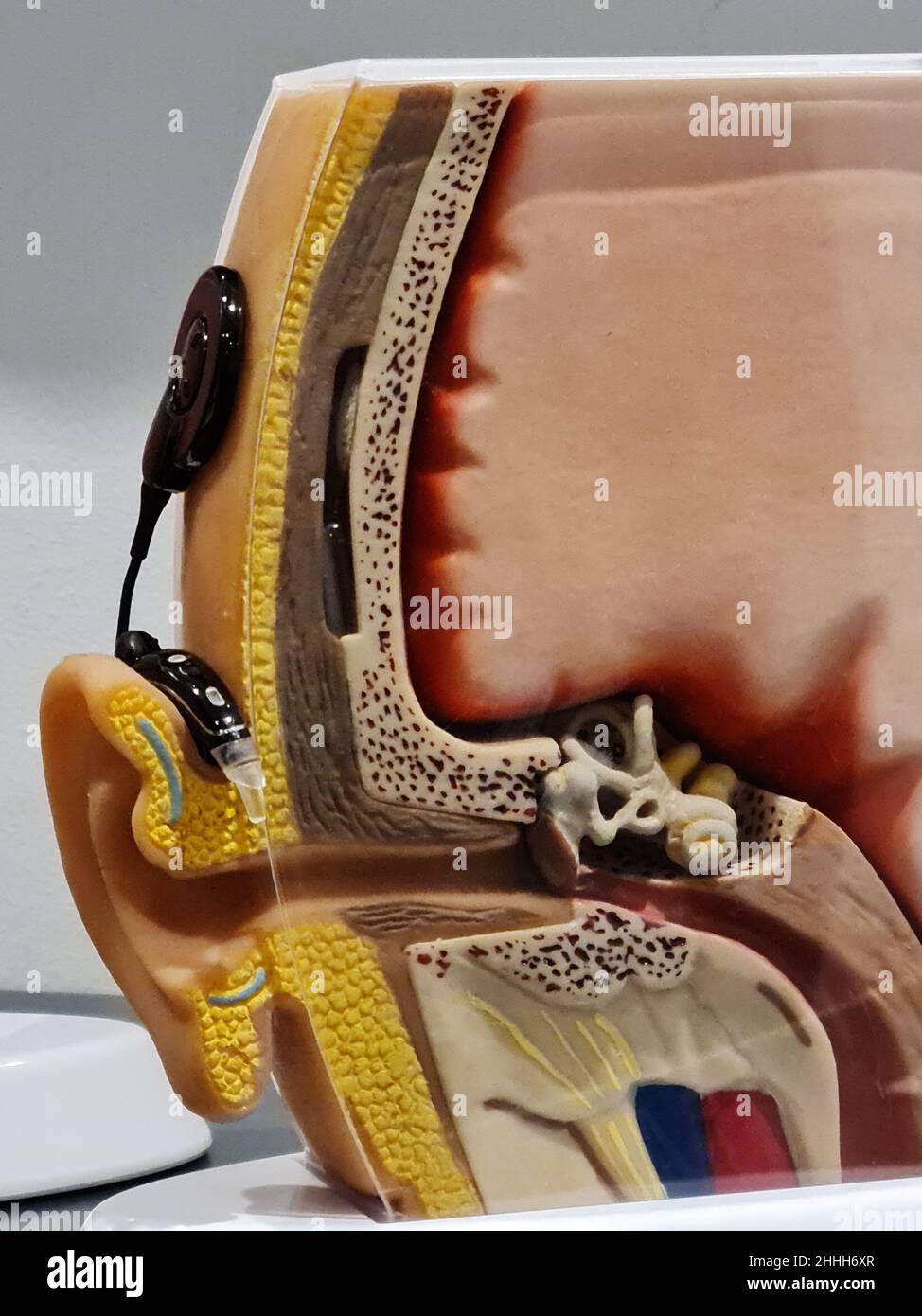 Cochlear implant Stock Photo