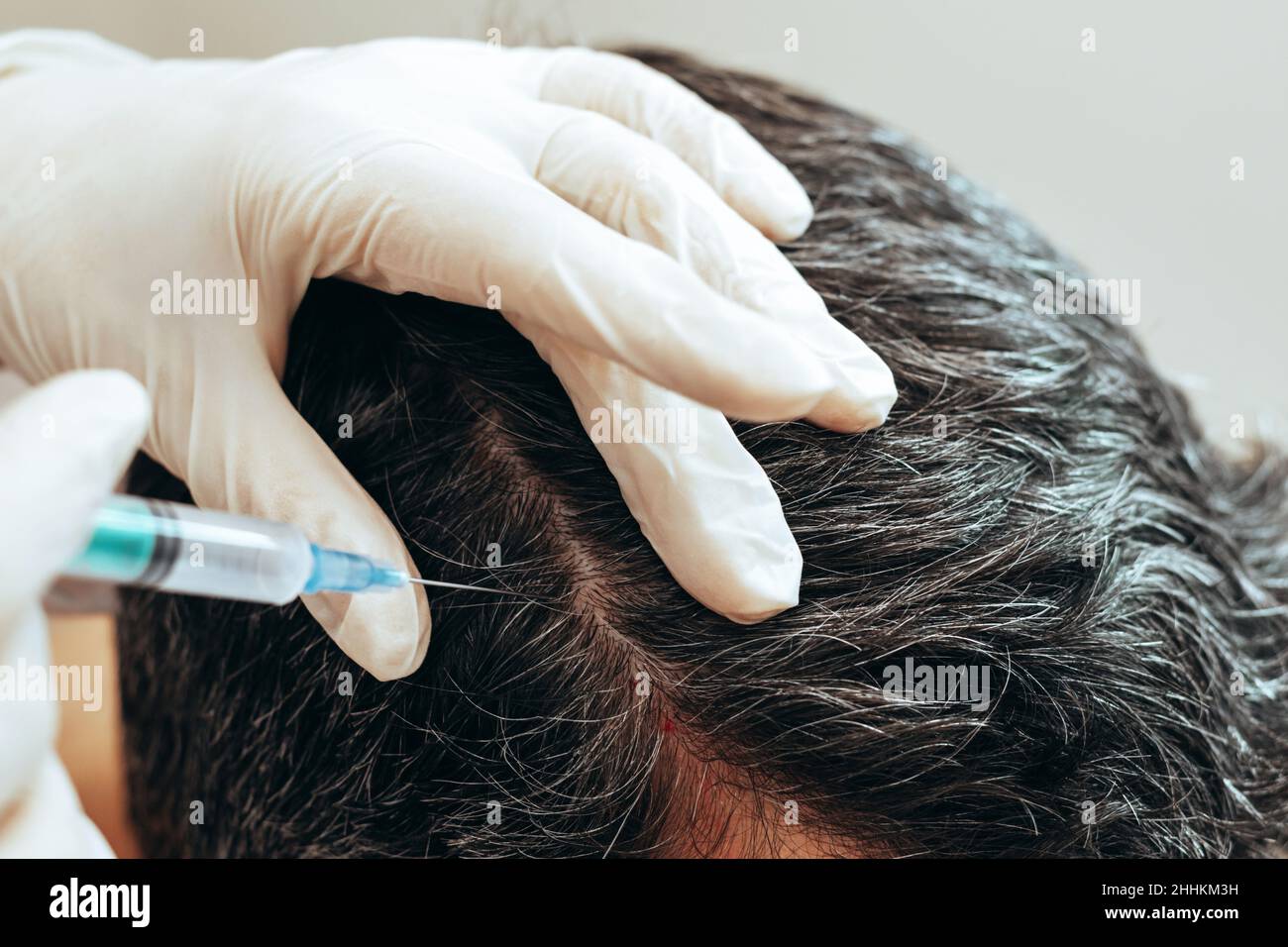 Cosmetologist performs anti-aging procedures injections hyaluronic acid  into scalp, hair growth prevention hair loss man Stock Photo - Alamy