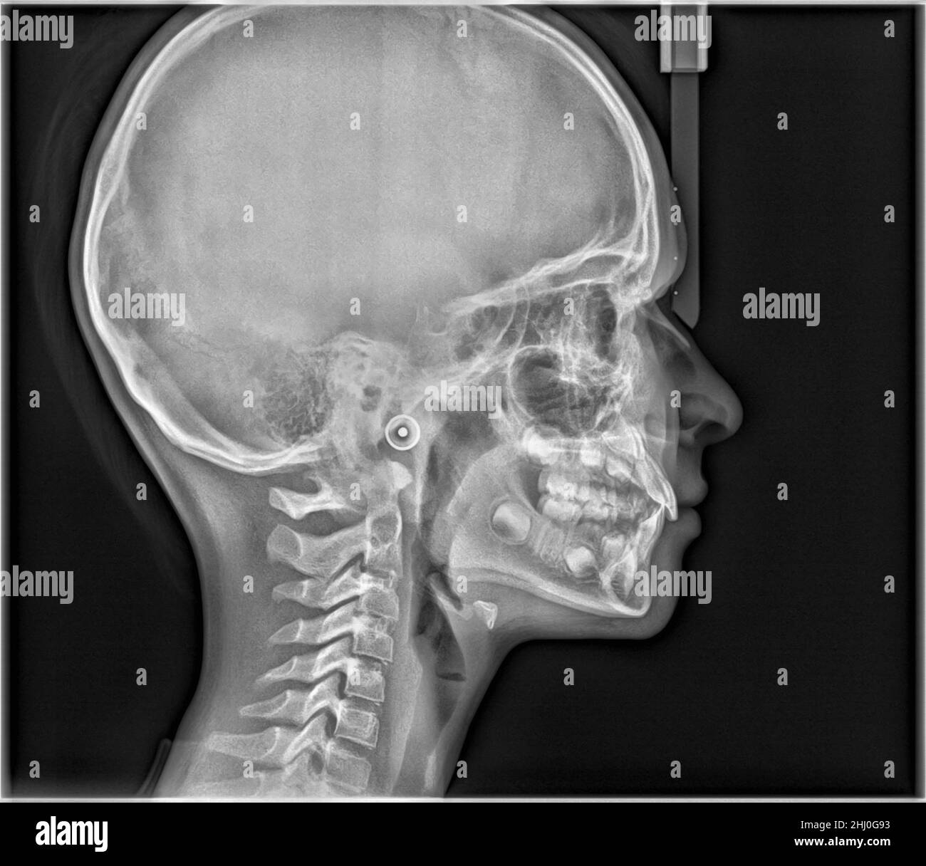 X Ray of human head skull, side view. Cranium medical analysis - Xray ...