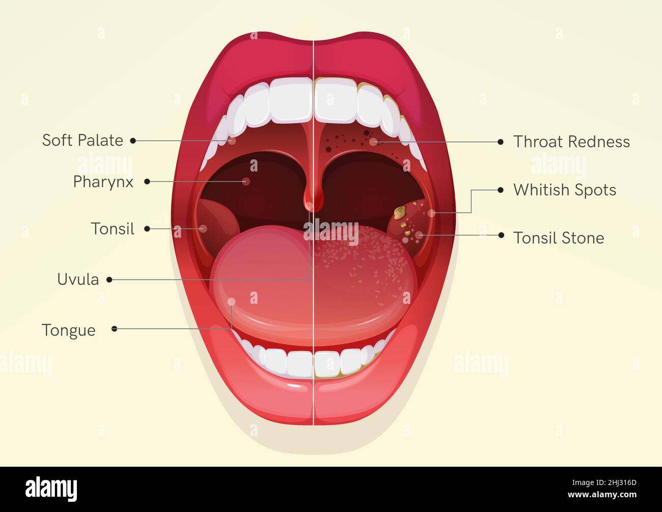 Open Mouth with Sore Throat and Tonsillitis  - stock illustration as EPS 10 File Stock Vector