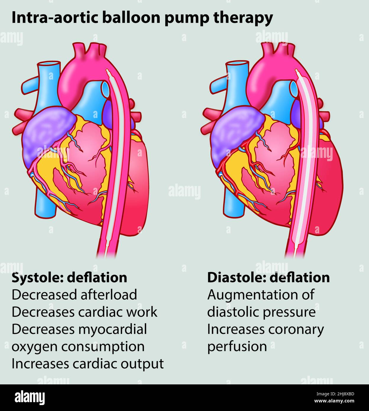 Two in a series of three medical diagrams illustration showing how the heart responds to intra-aortic balloon pump therapy. Educational biology topics Stock Photo
