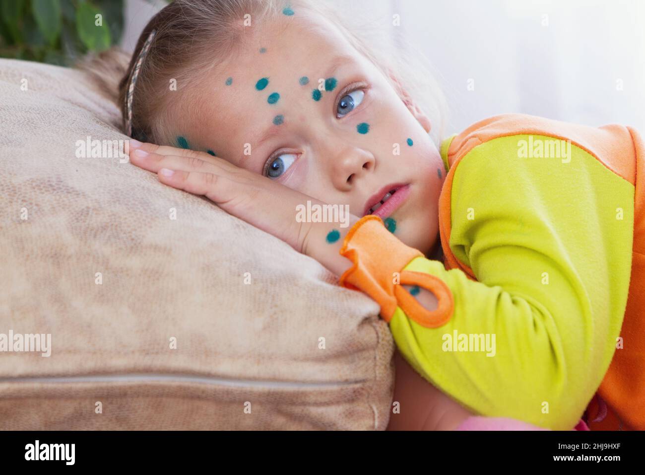 Portrait of a child girl suffering from chicken pox. Stock Photo