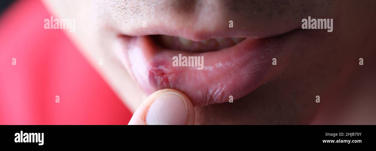 Herpes on male inner lip closeup. Symptoms and treatment of herpes Stock Photo