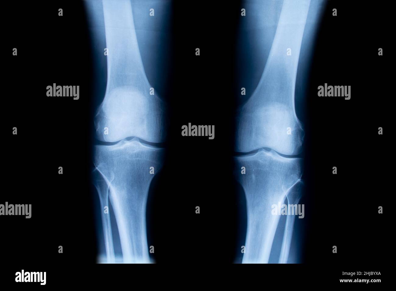 X-ray of human knees, closeup Stock Photo