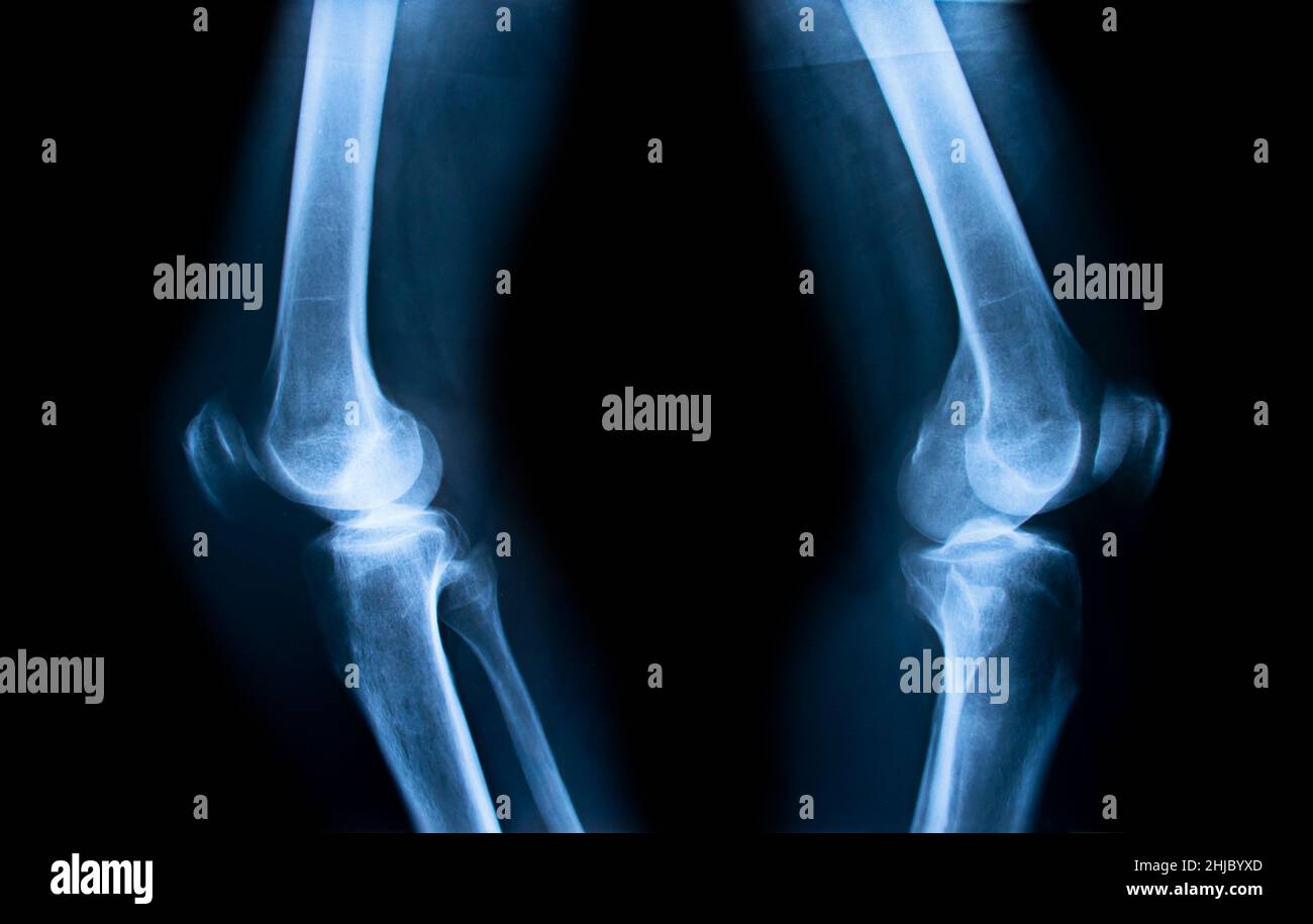 Closeup of xray of human knees Stock Photo Alamy