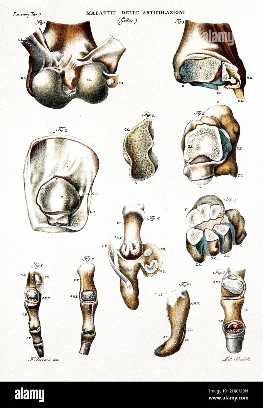 Several examples of diseased joints from gout. Colored lithograph by Batelli after Ferdinando Ferrari, c. 1843. Stock Photo