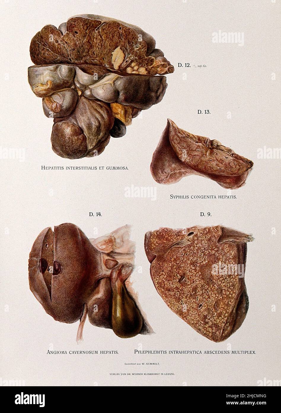 Chromolithograph illustrating liver disease in dissected specimens caused by hepatitis (top left), congenital syphilis (top right), angioma cavernosum hepatitis (bottom left), and pylephlebitis intrahepatica abscendens multiplex (bottom right). The plates were painted from hospital cases immediately after death. By W. Gummelt, 1897. Stock Photo