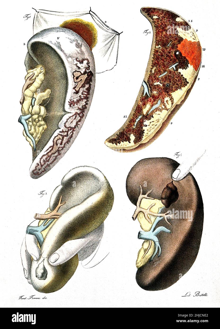 Four examples of diseased spleen. Colored lithograph by Batelli after Ferdinando Ferrari, c. 1843. Stock Photo