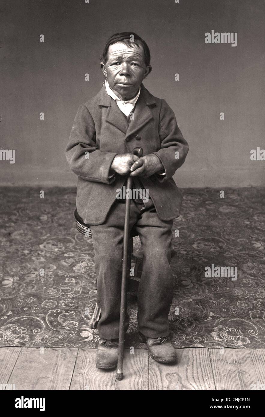 Portrait by Eugène Trutat (1840–1910) of a man with congenital iodine deficiency syndrome. The photograph is titled Joseph le crétin (Joseph the Cretin). Congenital iodine deficiency syndrome is a medical condition present at birth marked by impaired physical and mental development, due to insufficient thyroid hormone (hypothyroidism) often caused by insufficient dietary iodine during pregnancy. It is one cause of underactive thyroid function at birth, called congenital hypothyroidism, and also referred to as cretinism. If untreated, it results in impairment of both physical and mental develop Stock Photo