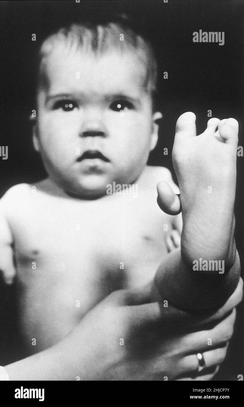 Shows 1962 photo of baby born with an extra appendage connected to the foot caused by the pregnant mother taking the drug Thalidomide. Stock Photo