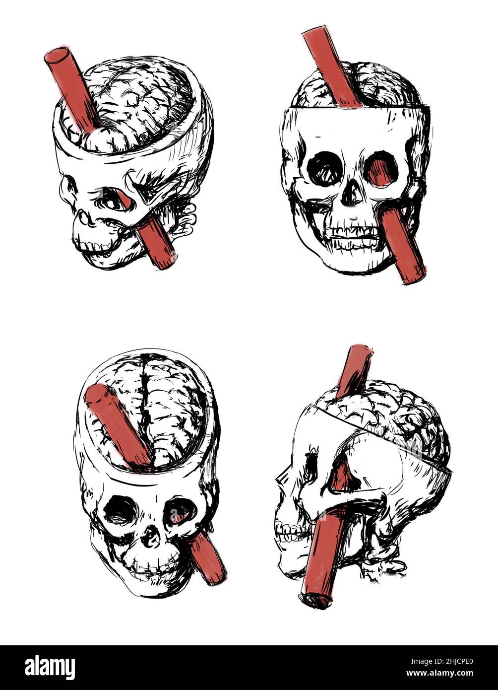 An illustration of the Brain injury of Phineas Gage. Phineas P. Gage, 1823-1860, was an American railroad worker that survived an accident in 1848 in which a large iron rod was driven through his head. The iron rod destroyed most of his left frontal lobe. The effects of the injury on his personality has been much debated as there is scant written evidence of what his behavior actually was for the twelve remaining years of his life. Stock Photo